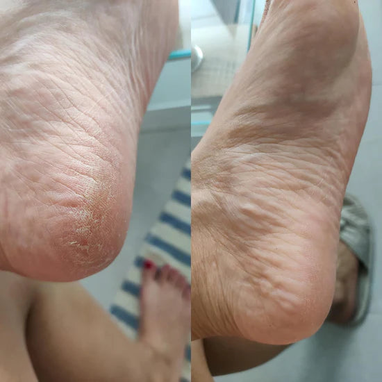 Anti-callosités - Boutique Ecom