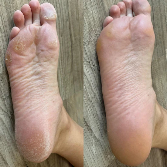 Anti-callosités - Boutique Ecom