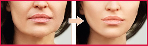 Ceinture de lifting du visage - Boutique Ecom